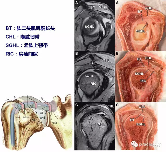 肩袖間隙的解剖及常見病變