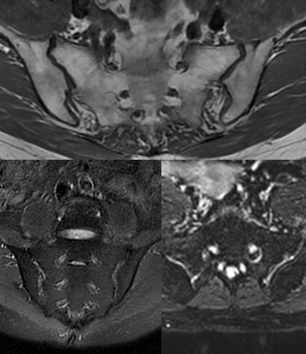 骶髂關節mri如何診斷早期強直性脊柱炎