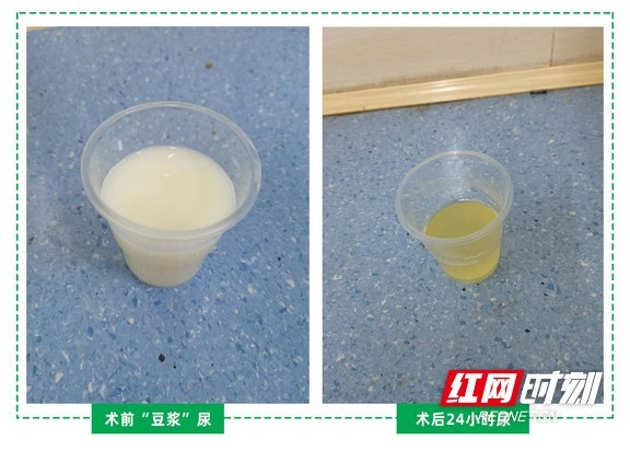 男子的尿液变成了乳白色竟是患上了乳糜尿