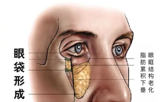 眼袋;而由于种种原因,眶隔膜包裹不住这些脂肪了,于是它们膨出了眼眶