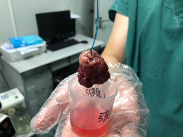 别再问我小息肉切不切它们都会长成这样