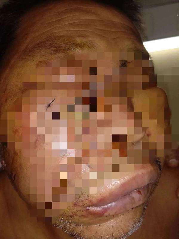 黑龙江男子上山采蘑菇与黑熊狭路相逢身上多处被咬伤血肉模糊