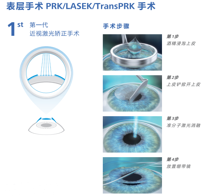 东莞3种激光近视手术,从几千块到2万多,哪种适合你?