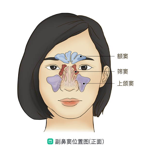 黏膜持续水肿,堵塞鼻窦腔在鼻腔的开口,副鼻窦内的分泌物无法及时排出
