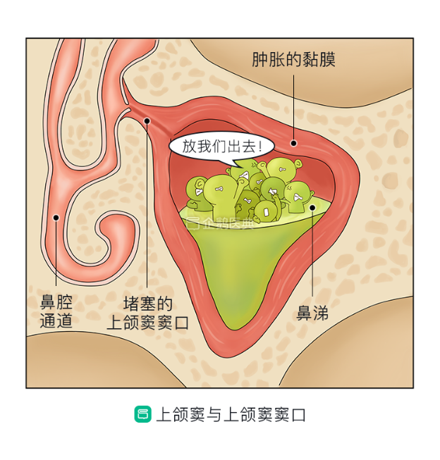 鼻窦积液排出姿势图片