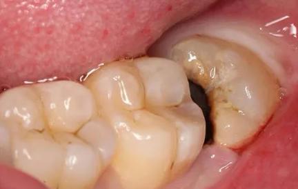 4,引发蛀牙智齿生长在最内侧,且可能没有咬合牙的关系,导致日常清洁不