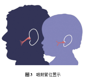 分泌性中耳炎|耳朵进水容易发炎？分泌性中耳炎了解一下