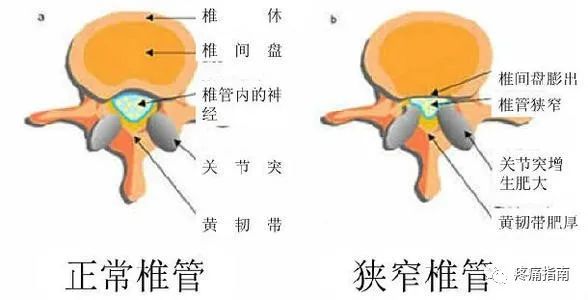 腰椎椎管狭窄症|腰椎椎管狭窄症推拿治疗技术