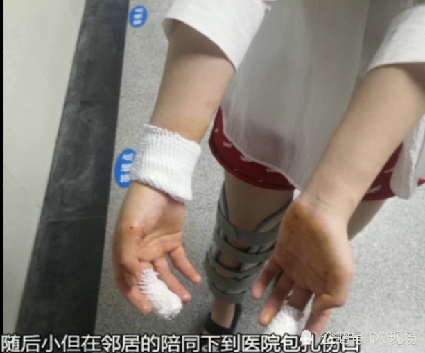 随后小但在邻居的陪同下到医院包扎伤口,医药费共700多元.