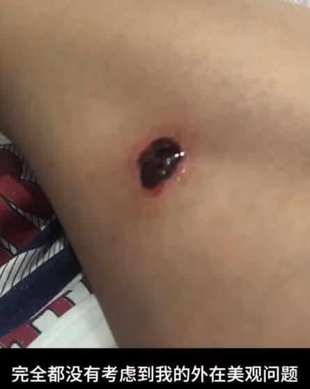 西安一模特花30万做丰胸手术身上留下10处抽脂创口