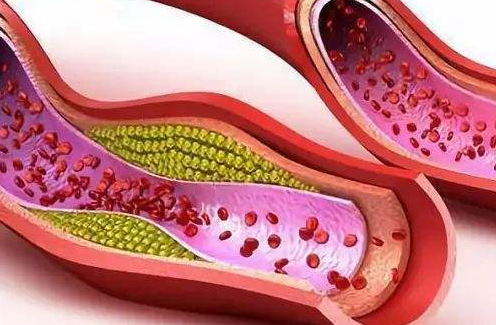血脂高|血脂高怎么办？医生：请收藏这份齐全的“降血脂”攻略，头不痛了