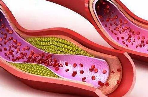 血脂高怎麼辦醫生請收藏這份齊全的降血脂攻略頭不痛了