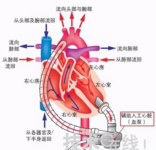 其存活率也超过了心脏移植的存活率,目前病人最长的存活期已超过15年