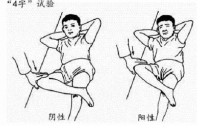 若病情进展到塌陷期出现患肢短缩或有半脱位时,allis征为阳性,表现为