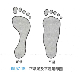 平足症的概述