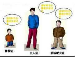 你了解过巨人症吗?