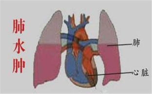 水肿|新生儿肺水肿是怎么造成的？