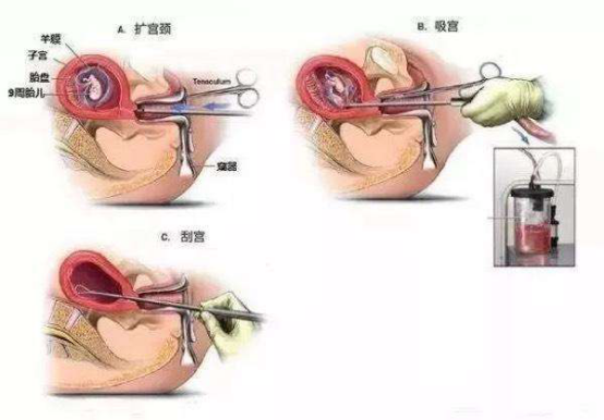 流产应该怎么处理
