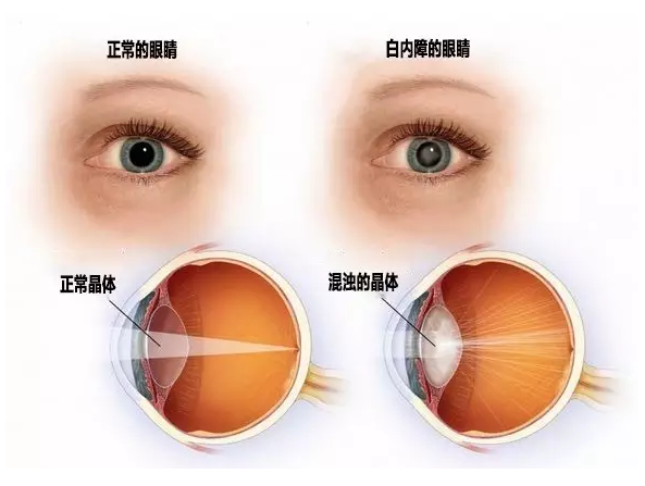 失明|什么叫做白内障
