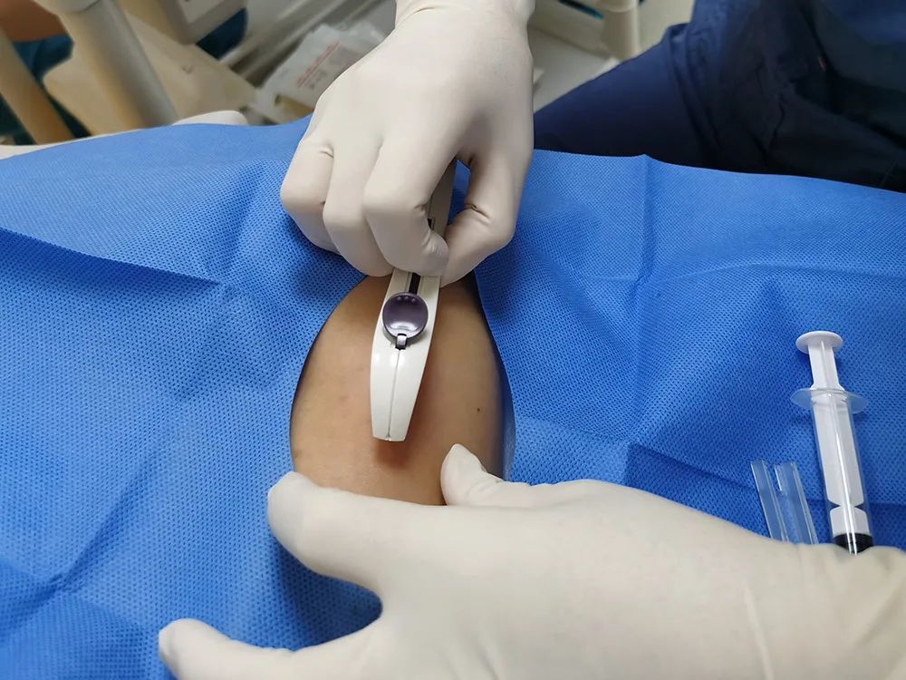 嵌进肉里大出血穿透子宫永别了伤害中国女性20年的小铜环