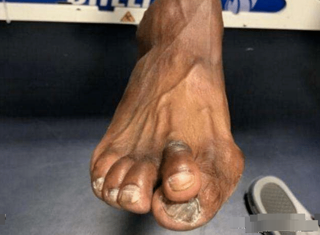 nba巨星训练有多苦请看看詹姆斯杜兰特和奥尼尔的脚趾