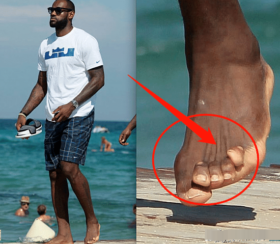 nba巨星训练有多苦请看看詹姆斯杜兰特和奥尼尔的脚趾