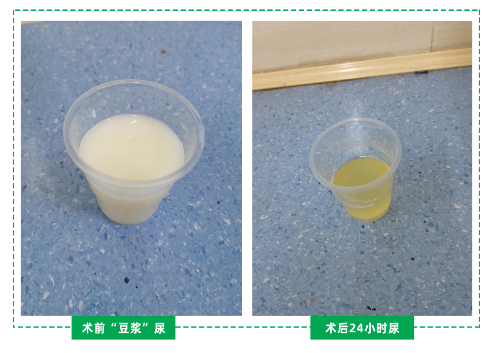 发病年龄以30～60岁为最高.根据严重程度将乳糜尿分为轻度,中度,重度.