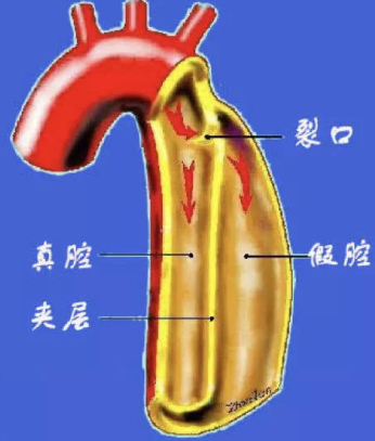 主动脉剥离在医学上称之为"主动脉夹层",是指由于各种病因,导致主动脉