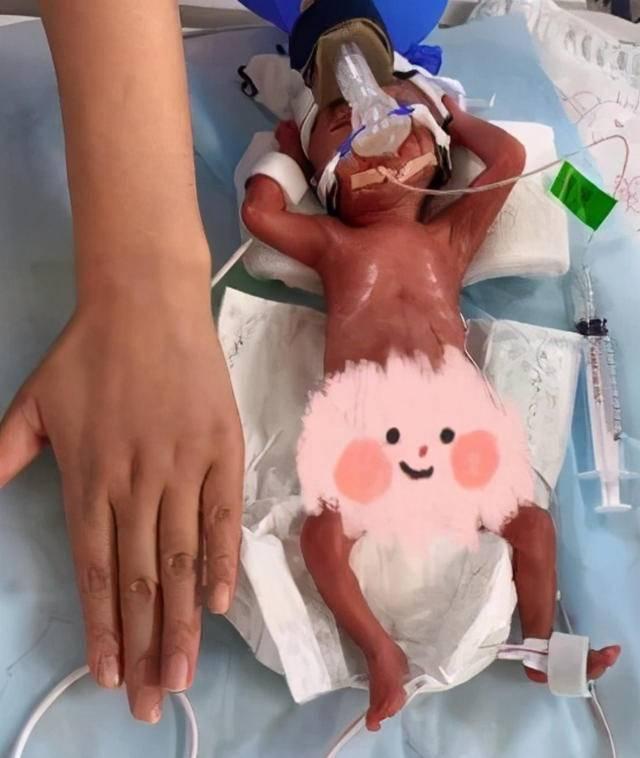 24周超早产儿出院,体重720克!婴儿能存活体重最低是多少?