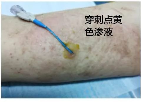 picc透明敷料处发生接触性皮炎后果严重,如何处理要知道