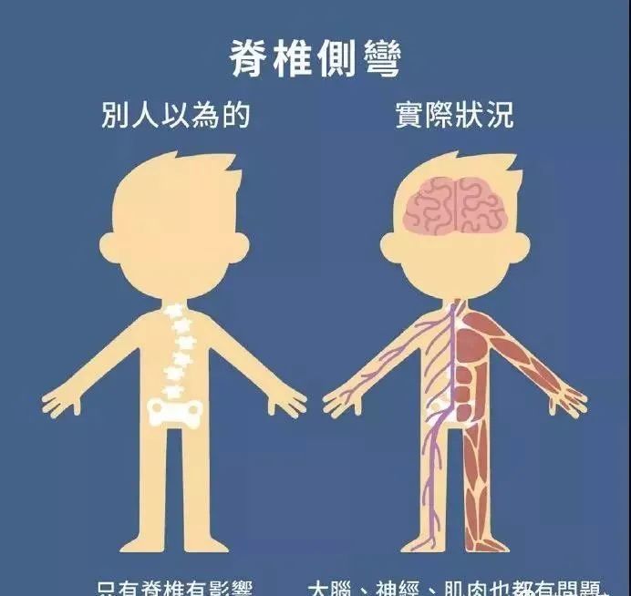 脊柱側彎不可忽視