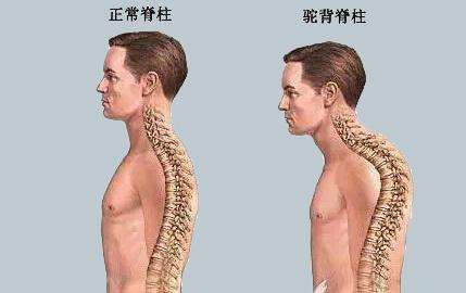 强直性脊柱炎发生驼背了还能治好吗