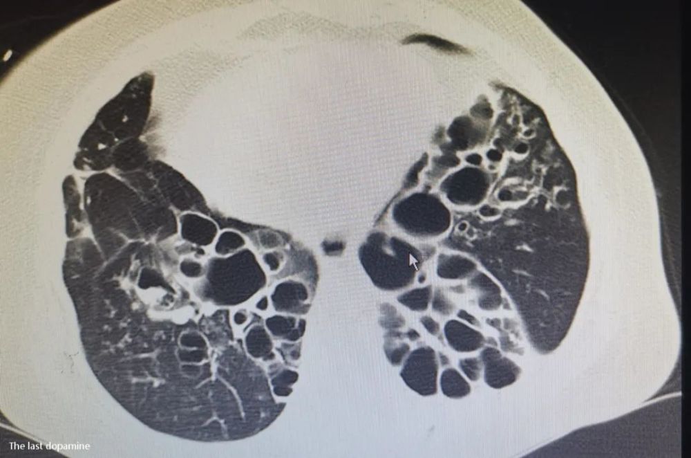 蝴蝶|48岁女病人两肺像极了蝴蝶，丈夫说对得起她了