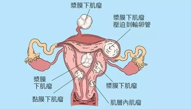 子宫肌瘤怀孕了有影响吗?