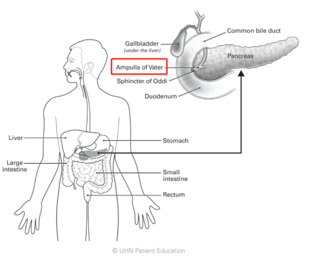 cancer,顾名思义,形成于人体的壶腹(ampulla of vater)部