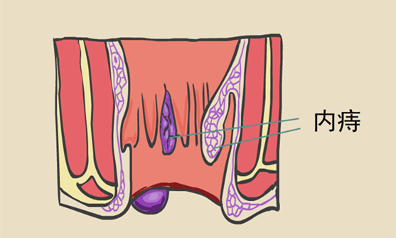 速看:什么是内痔