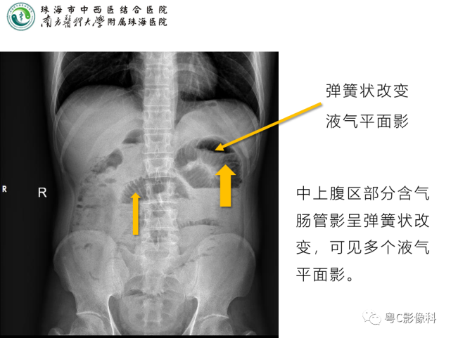 x线入门|腹平片x线摄影及常见急腹症的诊断