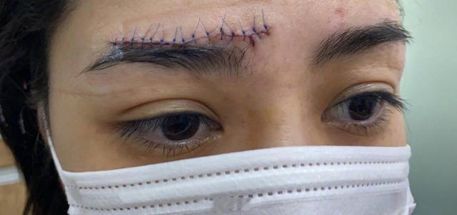 阿娇事故后首现身 自拍照 蜈蚣 伤口触目惊心 还好没毁容 腾讯新闻