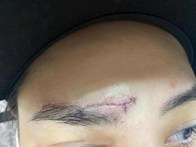 阿娇事故后首现身 自拍照 蜈蚣 伤口触目惊心 还好没毁容 腾讯新闻