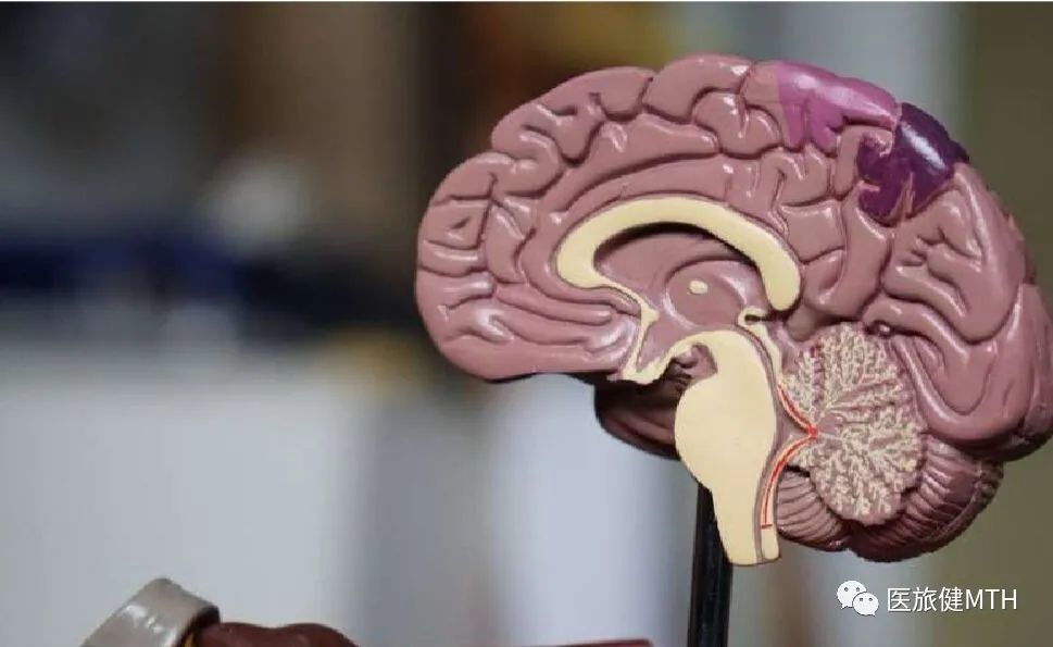 脑萎缩|在对45000名成人的研究中，发现160个与脑萎缩有关的基因