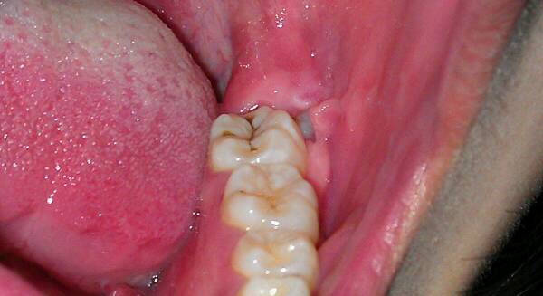 智齿为什么会有疼痛?口腔医生和你聊一聊_腾讯新闻