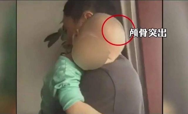 而三鹿奶粉事件,让很多孩子患上了肾结石,一度在社会出现严重反响的"