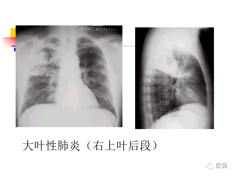 大叶性肺炎|大叶性肺炎的影像诊断