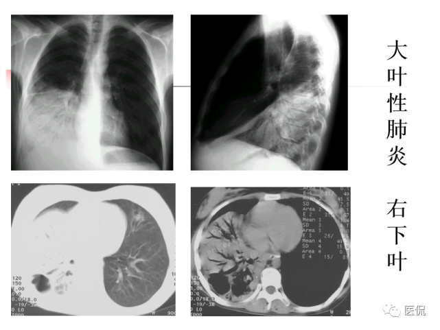 大叶性肺炎的影像诊断