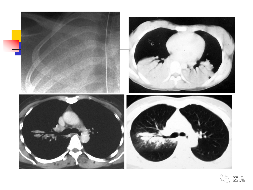 大叶性肺炎|大叶性肺炎的影像诊断
