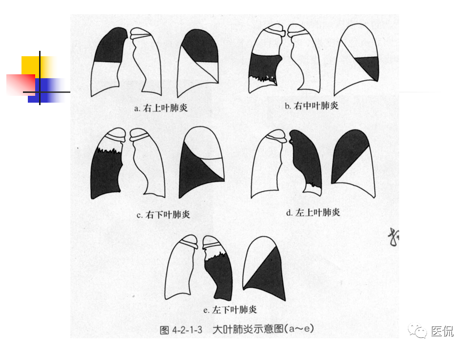 大叶性肺炎|大叶性肺炎的影像诊断