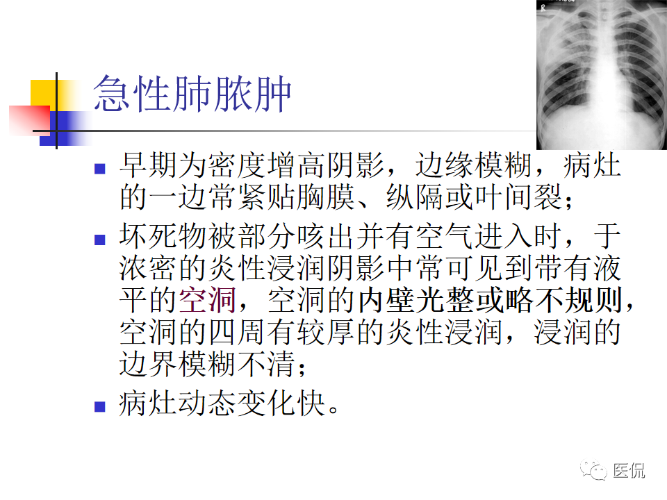 大叶性肺炎|大叶性肺炎的影像诊断