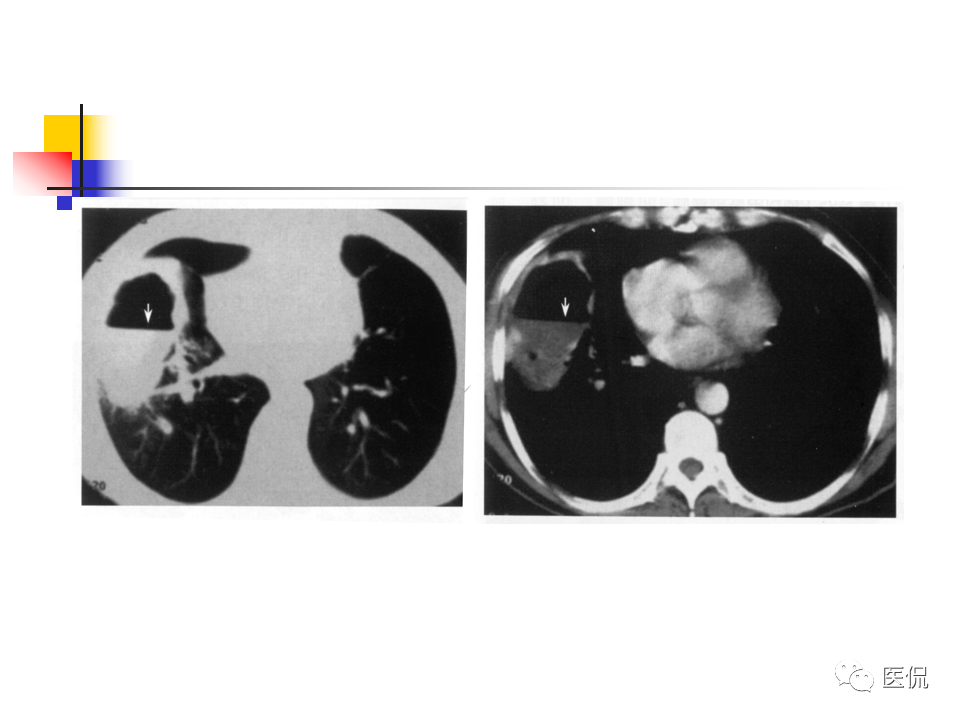 大叶性肺炎|大叶性肺炎的影像诊断