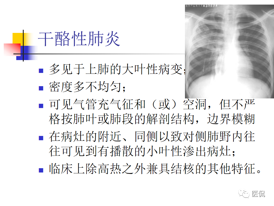大叶性肺炎|大叶性肺炎的影像诊断