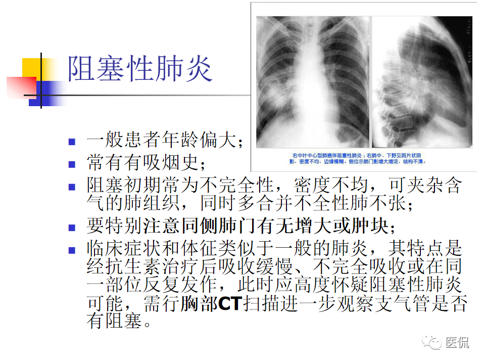 大叶性肺炎|大叶性肺炎的影像诊断